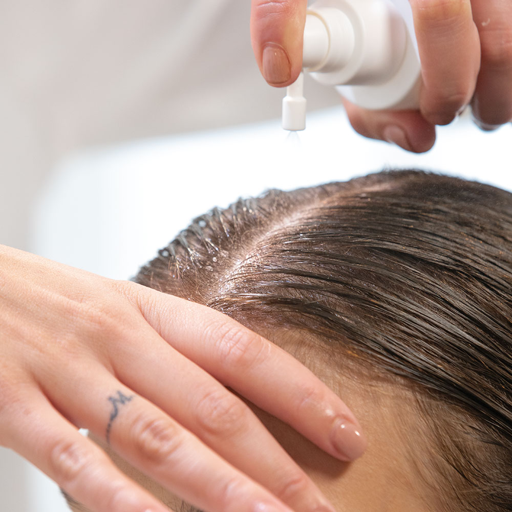 Scalp Lotion being applied onto scalp Scalp Lotion being applied onto scalp